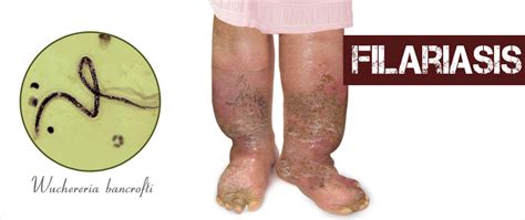 Filariasis Causes Symptoms Diagnosis And Treatment Faqs