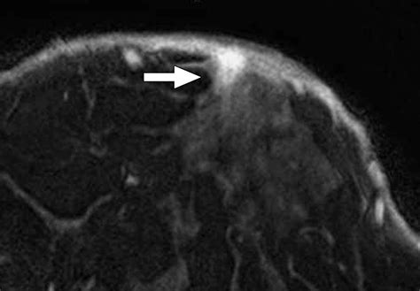 High Resolution Mri In Detecting Subareolar Breast Abscess Ajr