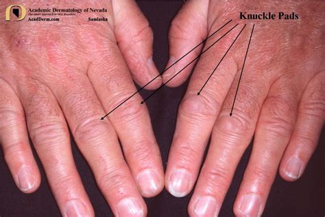 Knuckle Pads Heloderma Academic Dermatology Of Nevada