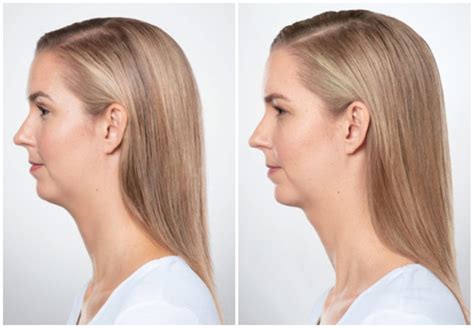 Kybella Before And After Altaire Clinic
