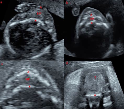 Normal Palate As Seen On The Axial Transverse View With 2d Ultrasound