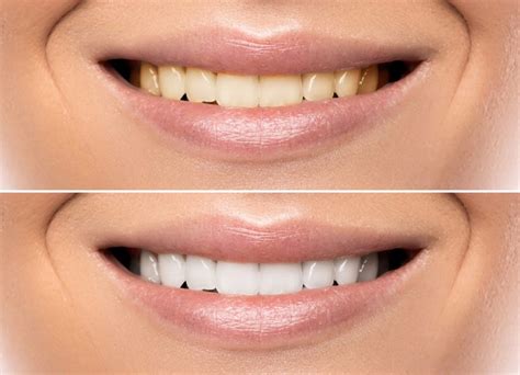 What Teeth Whitening Can And Can T Do Dr Gordon Bell