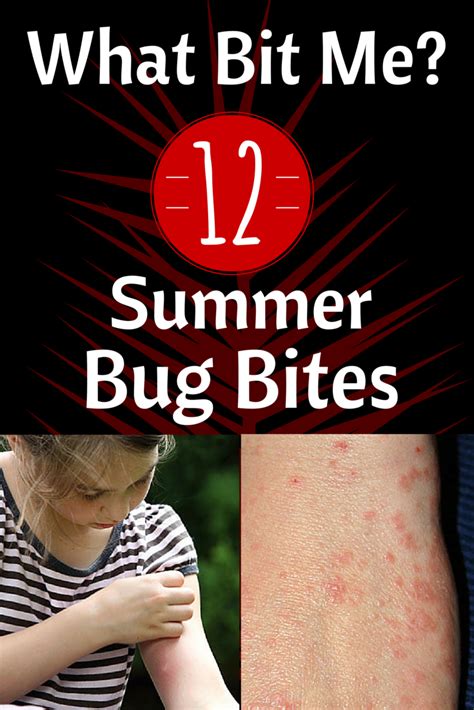 Pictures Of Different Types Of Mosquito Bites Peepsburghcom