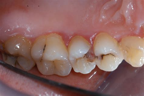 Cavities in front teeth are permanent damage that occurs as a result of a bacterial acid attack. Are Your Teeth Loosing Weight? - TeethFirst