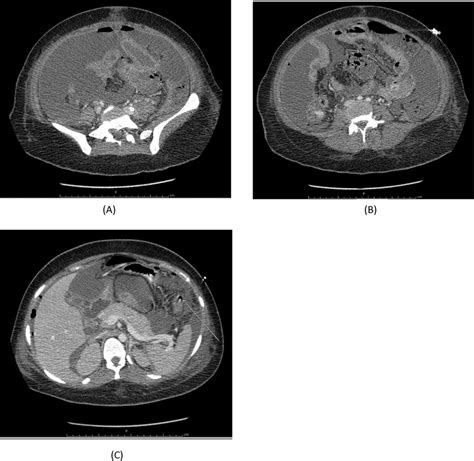 Contrast Enhanced Computerized Tomography Ct Scan Of The Abdomen