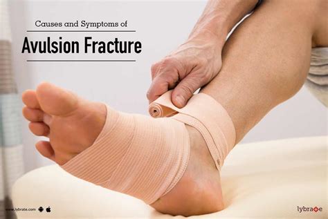 Causes And Symptoms Of Avulsion Fracture By Dr Mkaushik Reddy Lybrate
