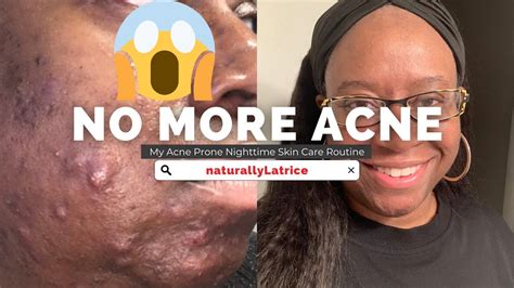 Clear Up Acne Detailed Nighttime Skincare Routine Breakouts Cystic