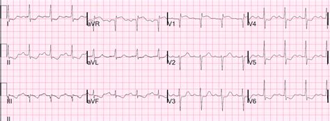 Dr Smiths Ecg Blog July 2014