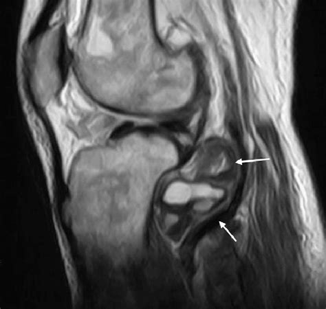 Right Knee T2 Weighted Sagittal Plane Mri Low Signal Intensity And