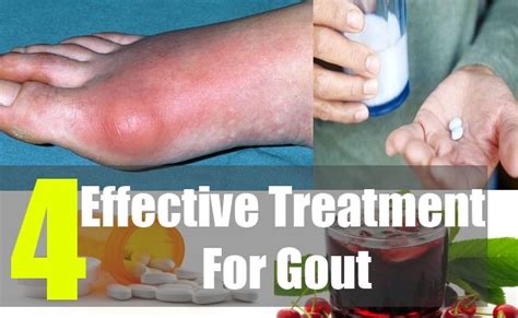 How To Alleviate Gout Pain In Big Toe