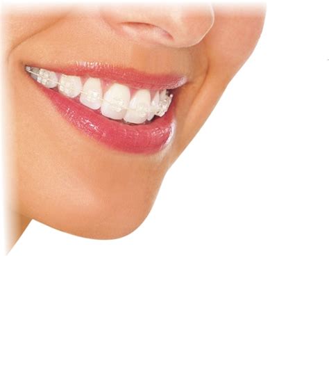 ortodoncia brackets frenillos alineadores dentart