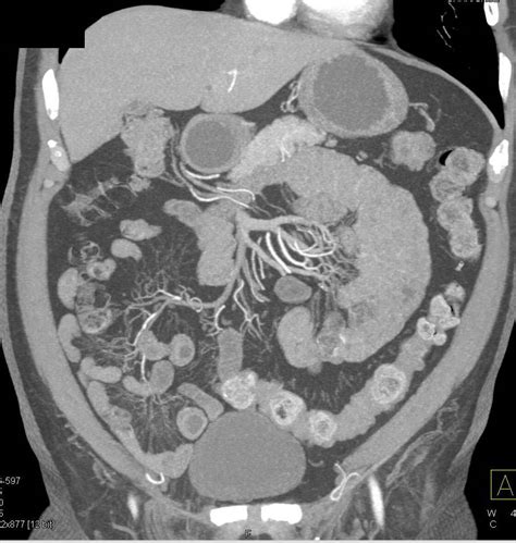 Normal Small Bowel Using Volumen And Iv Contrast At 30 Minutes Small