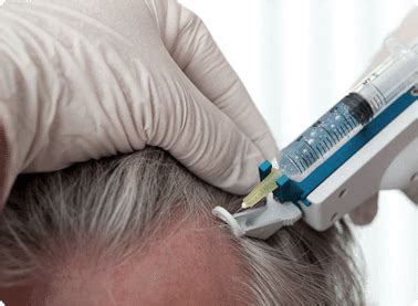That is why mesotherapy is such an effective treatment against hair loss that mainly stimulates new hair growth. Article on Mesotherapy as a Management for Hairloss