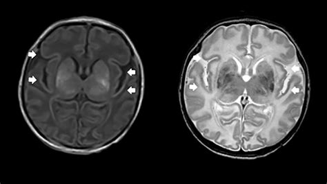E Example Of A Brain Mri Of A Term Asphyxiated Newborn Treated With