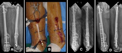 Lateral plating on a nailed femur. a Hypertrophic non ...