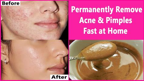 In 3 Days Permanently Remove Acne And Pimples Fast At Home Overnight