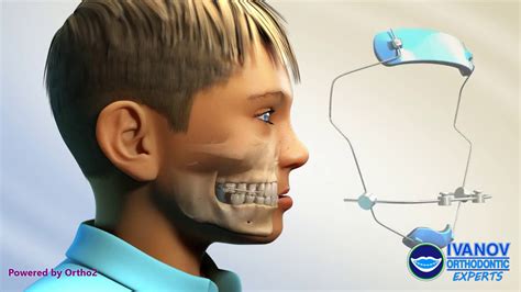 Orthopedics Facemask With Expander Youtube