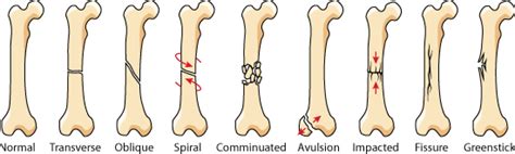 Different Types Of Bone Fracture Aslosweet