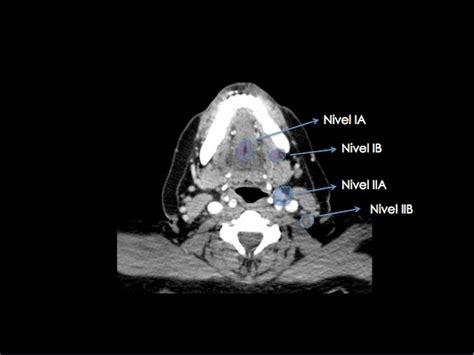 Imagenologia Udla 6to Semestre Ganglios Cervicales Nivel I