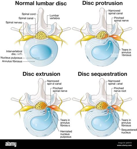Illustration Showing Normal Lumbar Disc And Disc Protrusion And Disc