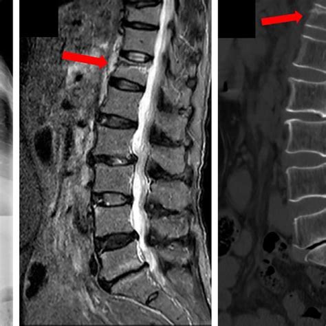 Case Two A 73 Year Old Female Patient A Preoperative Lumbar And