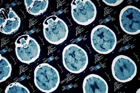 8 Warning Signs Of A Brain Tumor Umms Health