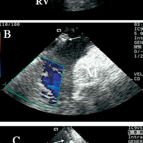 Intracardiac Echocardiographic Views Showing Right Atrium Ra Right