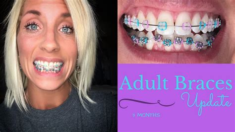 Braces As Adult Sexy Boobs Pics