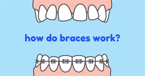 How Does Orthodontic Treatment Work Thomas Orthodontics