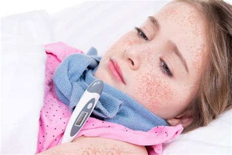 Scarlet Fever In Children Causes Symptoms And Treatment
