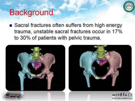 Application Of Triangular Osteosynthesis For Vertically Unstable Sacral