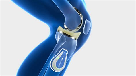 Smart Implants And Biomaterials Orthopaedic Surgeon Australia