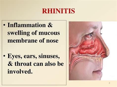 Ppt Pharmacological Treatment Of Acute And Chronic Rhinitis Cough