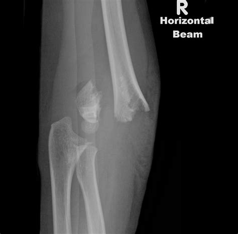 Aoota Classification Of Distal Humeral Fractures Wikidoc
