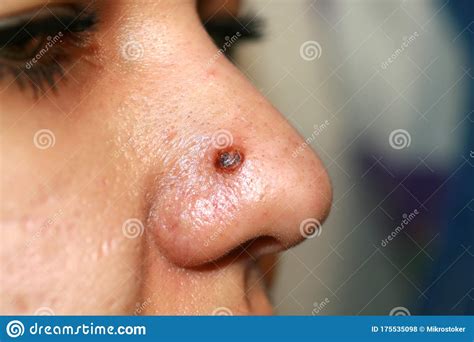 Inflamed Pimple On Nose Cyst Acne Acne On The Skin Stock Photo