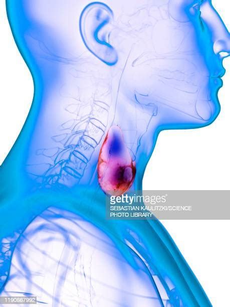 Goiter Photos And Premium High Res Pictures Getty Images