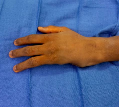 Not The Typical Hand Deficiency Ulnar Cleft Hand Congenital Hand And