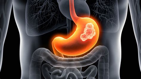 8 Common Symptoms Of Gastric Cancer Health News Hub