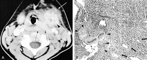 Cervicofacial Actinomycosis Ct And Mr Imaging Findings In Seven