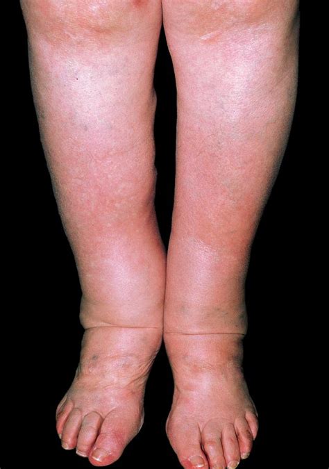 Get insights on various causes, symptoms, treatment, is elephantiasis contagious? Elephantiasis Photograph by Dr. R. Triller/science Photo ...