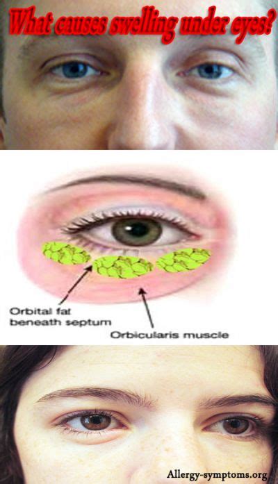 Periorbital Edema Causes And Treatment Allergy