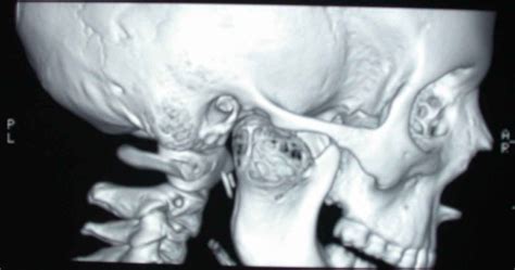 Aneurysmal Bone Cyst Located In The Mandibular Condyle Head And Face