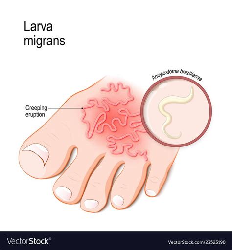Cutaneous Larva Migrans Skin Disease In Humans Vector Image Human