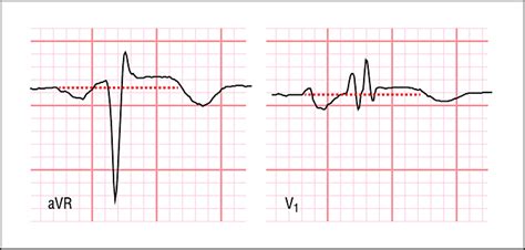 Significance Of St Segment Elevation In Lead Avr—diagnosis Valvular