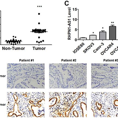 Up Regulated Expression Of Rhpn1 As1 In Ovarian Cancer Tissue And Cell