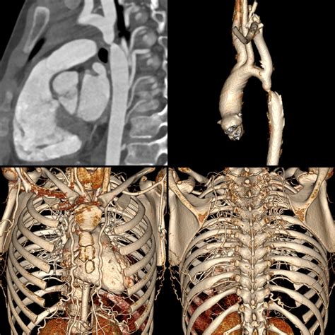 Coarctation Of Aorta Pediatric Radiology Reference Article