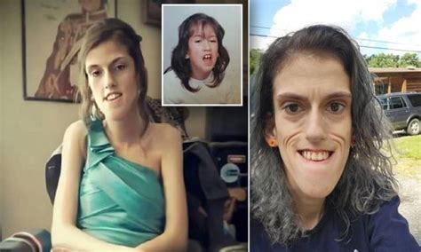 Mother Born With A Rare Muscle Condition That Left Her With Facial