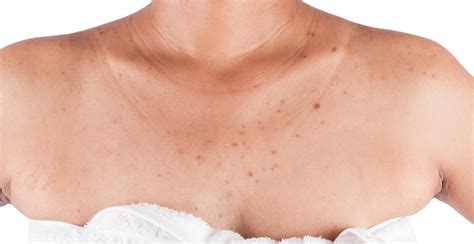 Chest Acne Causes Treatments And Prevention Clinikally