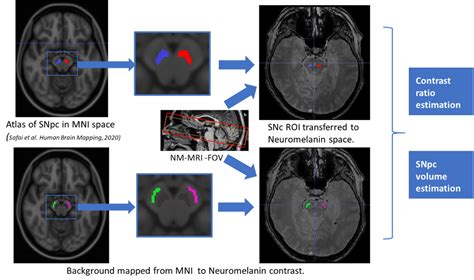 Characterization Of Neuromelanin Mri As A Potential Parkinsons Disease
