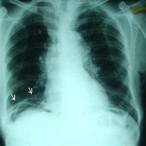 A Plain Erect Chest Radiograph Showing Appearance Of Radiolucency Under